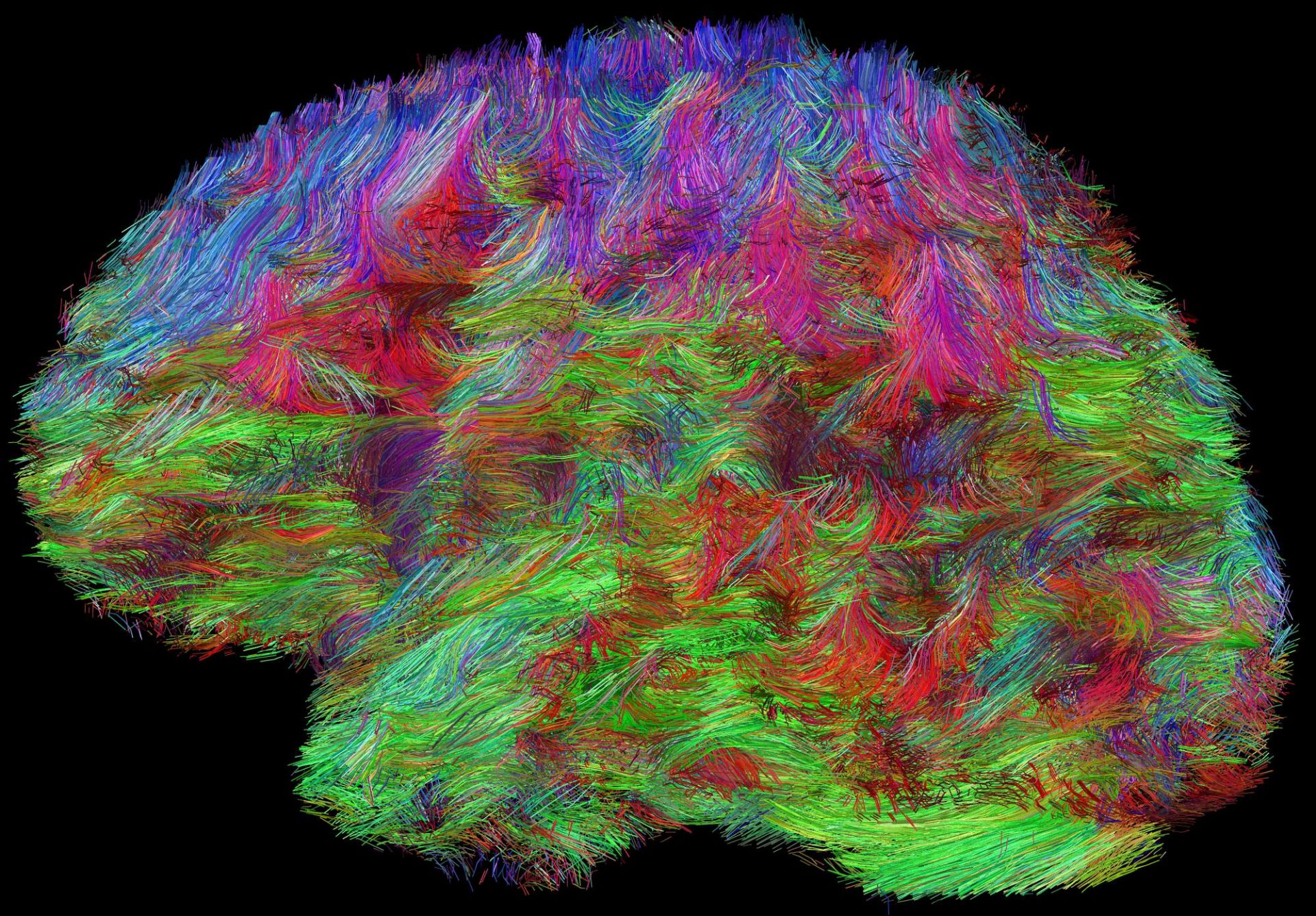 A reconstruction of human brain connections by a method of water molecule diffusion imaging